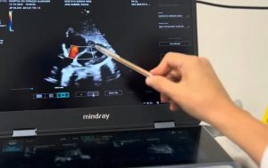 Hospital do Coração Alagoano utiliza ecocardiograma para aprimorar cirurgias cardíacas em crianças