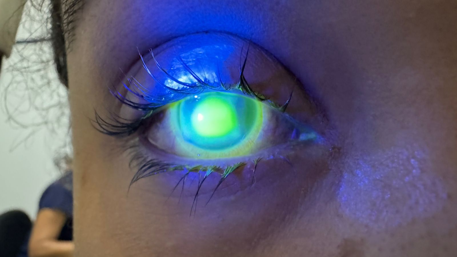 Leia mais sobre o artigo Oftalmologista do HGE alerta sobre o cuidado com os olhos durante o Carnaval